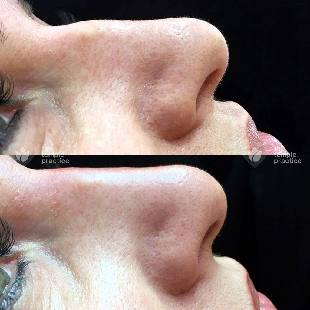 Non-Surgical Rhinoplasty before and after 3
